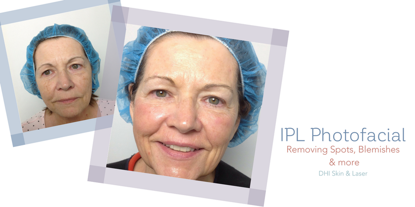 IPL Photofacial | Removing Freckles, Sun Spots, Age Spots, and Rosacea