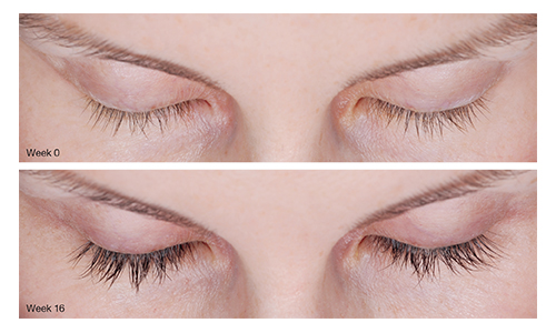 results from latisse eyelash growth product