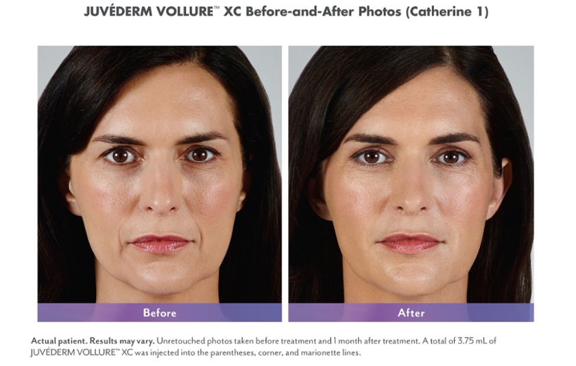 dermal fillers facial fillers for the parentheses