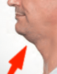 kybella for double chin after picture