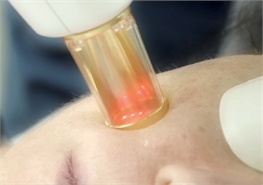 laser skin resurfacing laser skin treatment