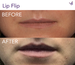 botox for lips before after