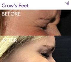 botox and crow's feet before after picture