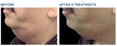 underchin fat reduction and skin tightening laser treatment