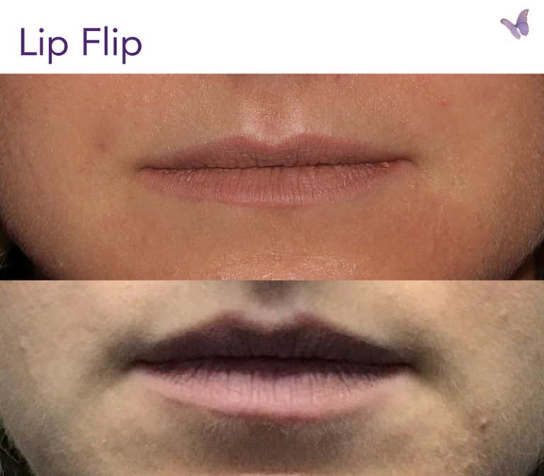 How Lasers Treat Smokers Lines Above Your Upper Lip Derma Health
