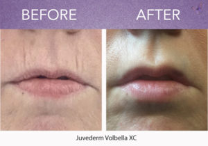 How Lasers Treat Smokers Lines Above Your Upper Lip - Derma Health Institute