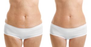 body contouring fat reduction liposuction laser treatment