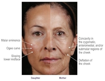 how fillers prevent the look of aging