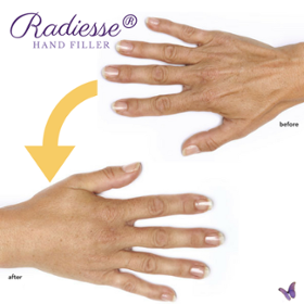 radiesse filler for aging hands