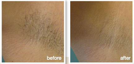 Laser Hair Removal Under Arms