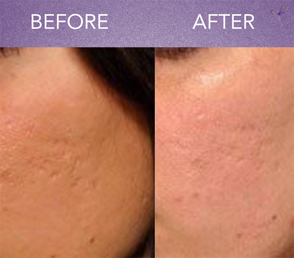 How Many Sessions Of Microneedling For Acne Scars Medicine Acne