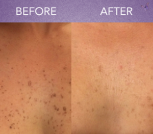 chest before after picture photofacial