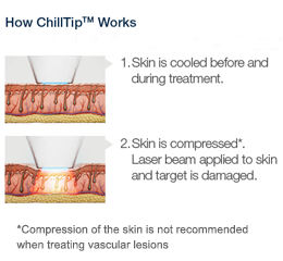 painless laser hair removal with chilltip