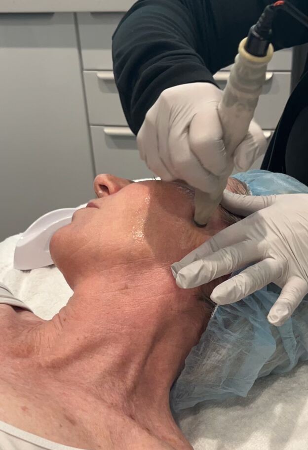 Microdermabrasion Exfoliation