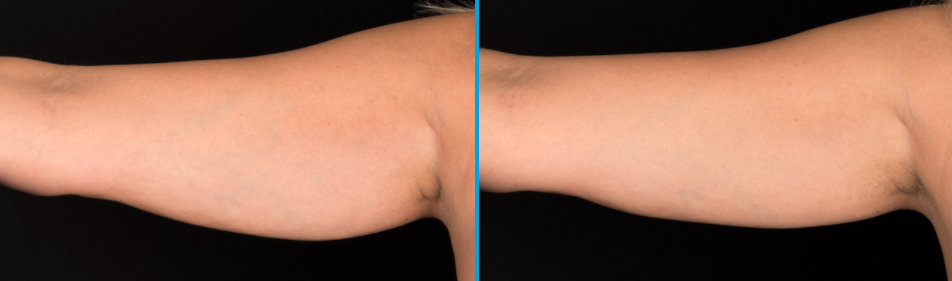 before after picture coolsculpt arm