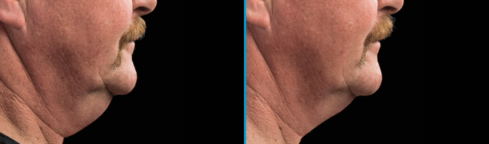 coolsculpting chin before after