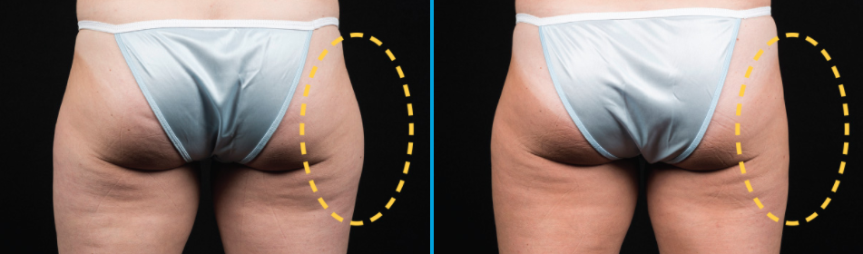 before after coolsculpt thigh
