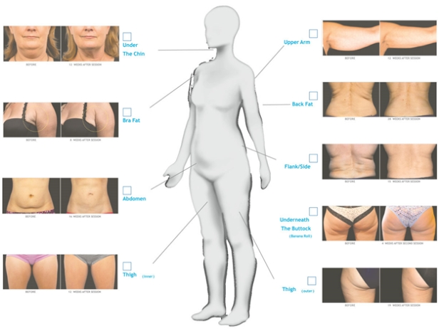 CoolSculpting® Upper Flanks