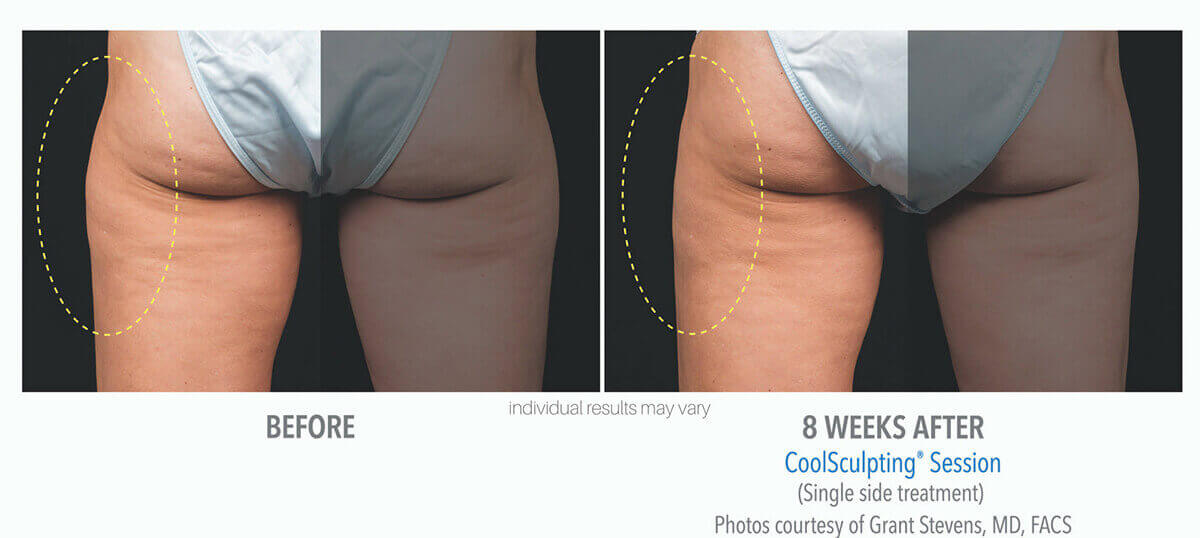 coolsculpting_before_and_after_cool-sculpting_skinney_medspa_3-1