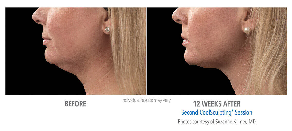 coolsculpting_before_and_after_cool-sculpting_skinney_medspa_6-1