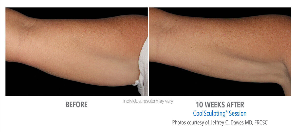 coolsculpting_before_and_after_cool-sculpting_skinney_medspa_7-1