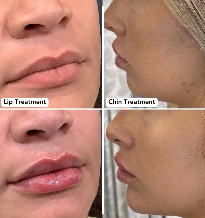 Juvederm Lip & Chin Treatments