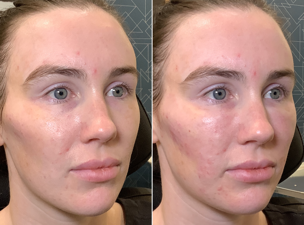 PRF facial injections