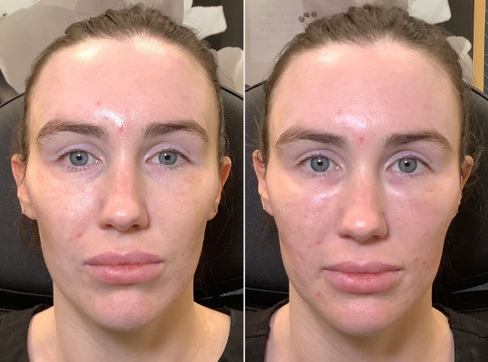 PRF facial injections