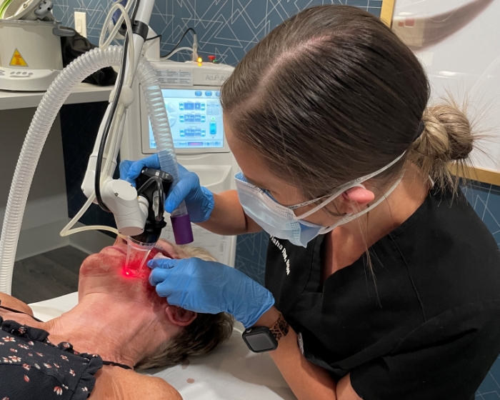 Featherlite CO2 Laser Resurfacing